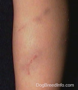 Close Up - Dog bite mark on a person's leg