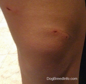 Close Up - Dog bite puncture wound above a persons knee