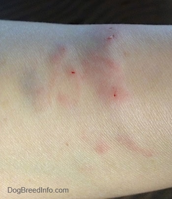 Close Up - Dog Bite mark on a persons forearm