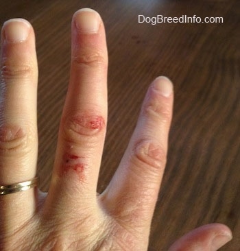 Close Up - Dog Bite on a middle finger