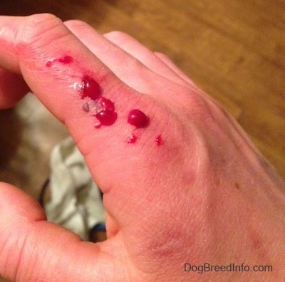 Close Up - Blood on a persons hand from a dog bite