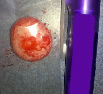 Kidney Stone on a sterile surface next to a pen